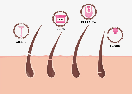 Depilação a Laser vs. Fotodepilação: Entenda as Diferenças