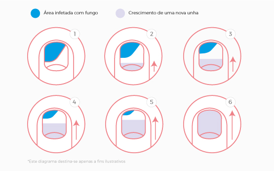 6 dicas para tratar as unhas quebradiças, frágeis e com manchas