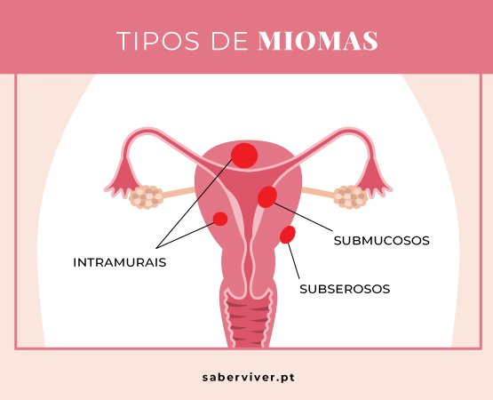 tipos de mioma uterino