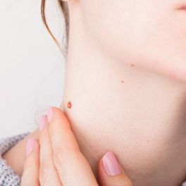 Entenda o melanoma e recorde a importância de cuidar bem da pele