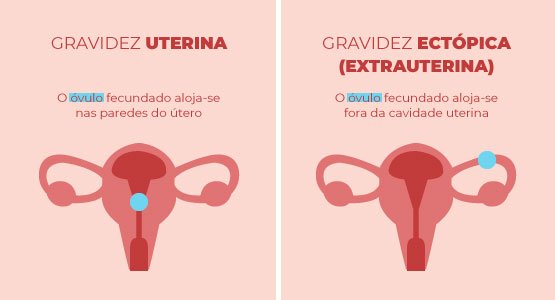 gravidez uterina versus gravidez ectopica