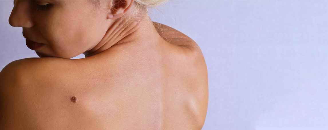 Melanoma: esteja atenta aos sinais da sua pele