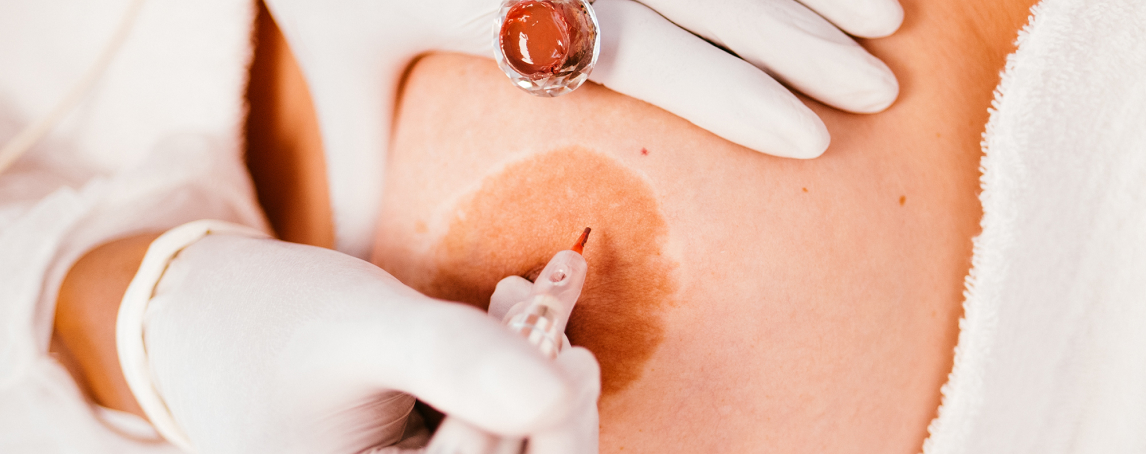 Micropigmentação: o procedimento que pode mudar a vida das sobreviventes do cancro da mama