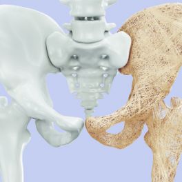 Osteoporose: a doença que afeta uma em cada três mulheres a partir dos 50 anos