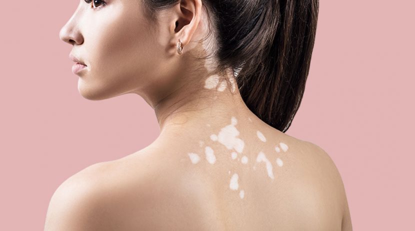 Diabetes e vitiligo: qual a relação?