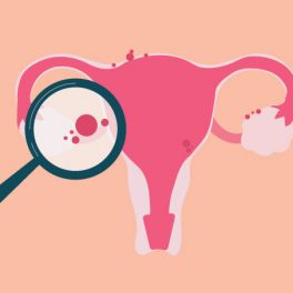 Endometriose: o que é esta doença crónica associada à infertilidade?