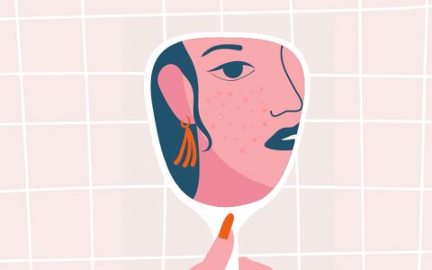 Mas afinal, o que é a acne hormonal? E como tratá-la?