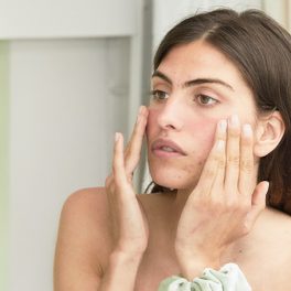 Aprenda a tratar da acne com produtos naturais (e eficazes)