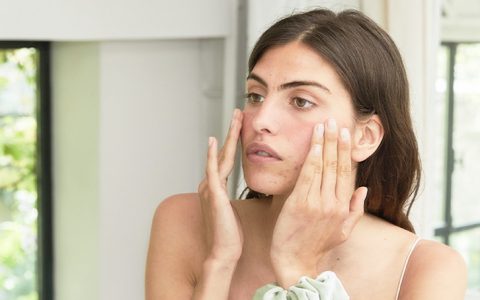 Aprenda a tratar da acne com produtos naturais (e eficazes)