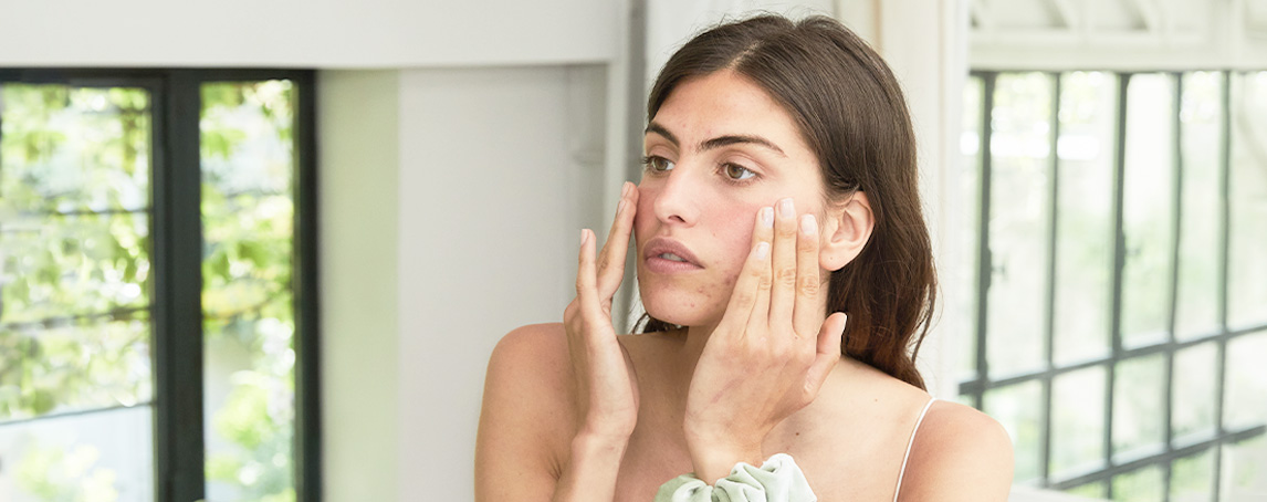 Aprenda a tratar da acne com produtos naturais (e eficazes)