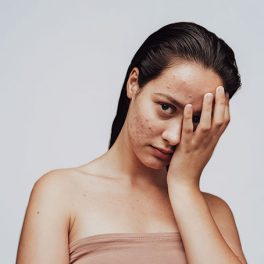 Mitos e factos sobre a acne