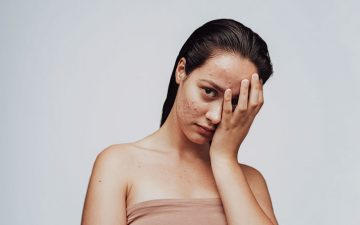 Mitos e factos sobre a acne