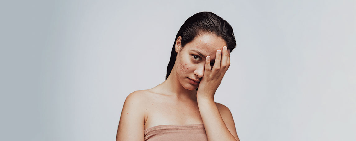 Mitos e factos sobre a acne