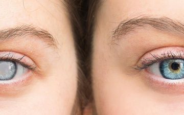 6 perguntas e respostas sobre o glaucoma
