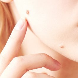 Presta atenção aos seus sinais? Saiba como e quando deve removê-los