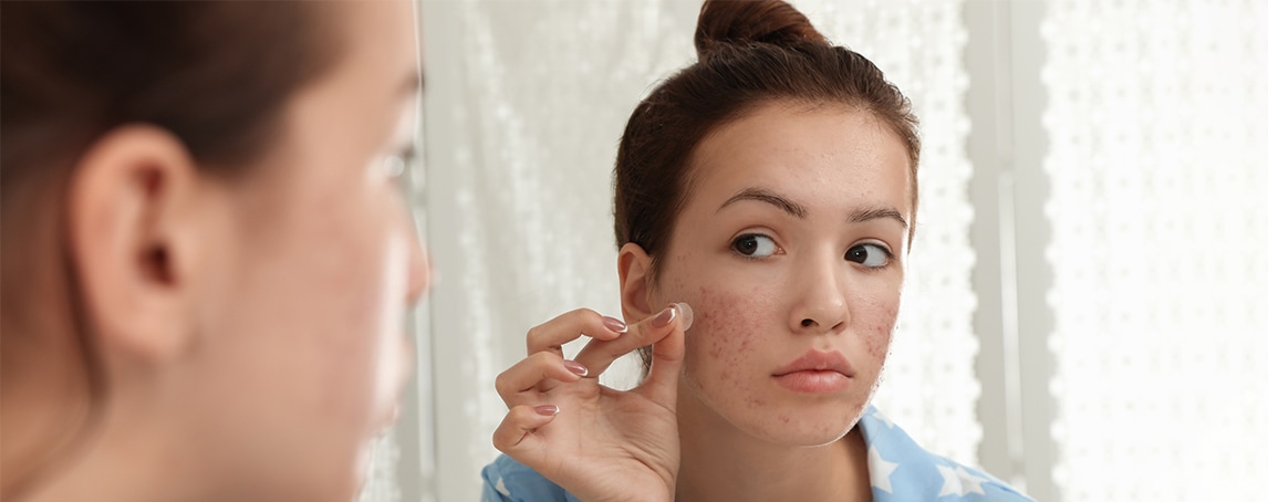 Descubra os acne patches, os salva-vidas das borbulhas