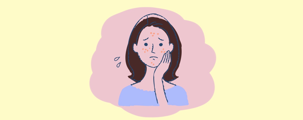 #Afinal, usar maquilhagem todos os dias contribui para o aparecimento de acne?