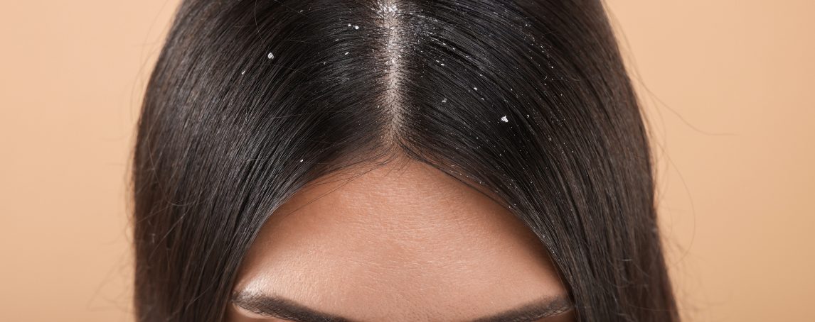 Caspa: causas, tipos e como cuidar