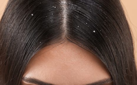 Caspa: causas, tipos e como cuidar