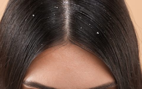 Caspa: causas, tipos e como cuidar